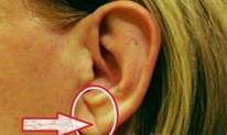 Ukoliko vam uši imaju ovaj detalj, pazite se srčanog udara