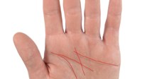 Nedostatak željeza vidi se na dlanovima, obratite pažnju na ove simptome