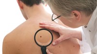 Pojava melanoma u BiH u porastu